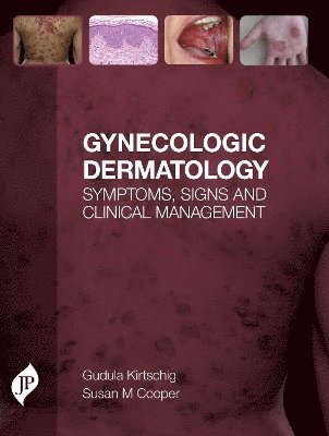 bokomslag Gynecologic Dermatology