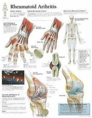 bokomslag Rheumatoid Arthritis