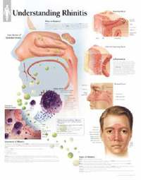 bokomslag Effects of Rhinitits