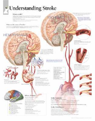 bokomslag Understanding Stroke, Laminated Chart