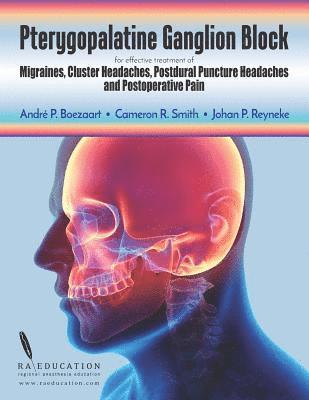 Pterygopalatine Ganglion Block: for effective treatment of Migraine, Cluster Headache, Postdural Puncture Headache & Postoperative Pain 1