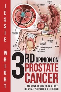 bokomslag 3rd Opinion on Prostate Cancer