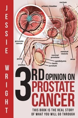 3rd Opinion on Prostate Cancer 1