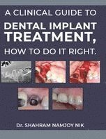 bokomslag A guide to dental implant treatment, how to do it right.