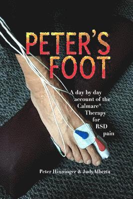 Peter's Foot: Calmare Treatment for RSD Pain Relief 1