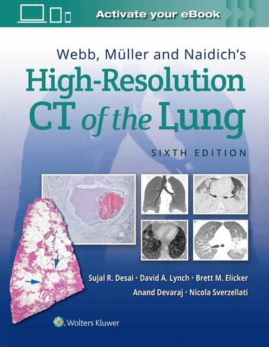 Sujal Desai, David Lynch, Brett M Elicker, Anand Devaraj, Nicola Sverzellati - Webb, Müller and Naidich's High-Resolution CT of the Lung, Inbunden