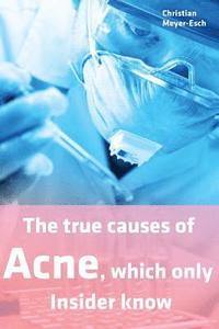 bokomslag The true causes of Acne, which only Insider know