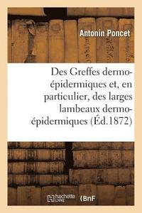 bokomslag Des Greffes Dermo-pidermiques Et, En Particulier, Des Larges Lambeaux Dermo-pidermiques