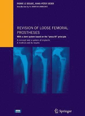 Revision of loose femoral prostheses with a stem system based on the 'press-fit' principle 1