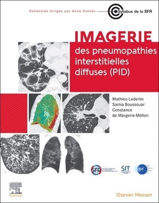 Imagerie des pneumopathies interstitielles diffuses (PID) 1