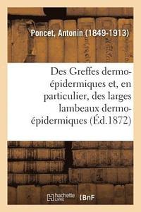 bokomslag Des Greffes Dermo-pidermiques Et, En Particulier, Des Larges Lambeaux Dermo-pidermiques