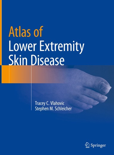 Tracey C. Vlahovic, Stephen M. Schleicher - Atlas of Lower Extremity Skin Disease, Inbunden