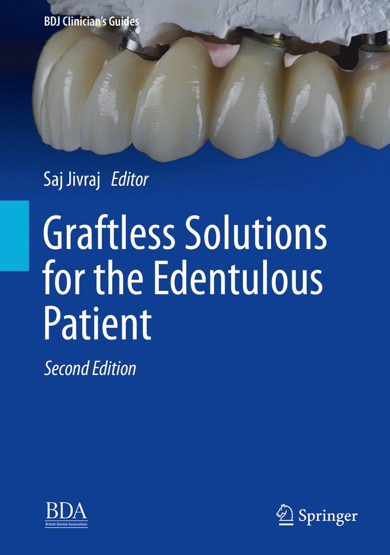 Saj Jivraj - Graftless Solutions for the Edentulous Patient, Inbunden