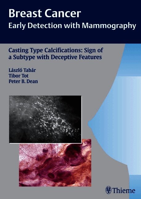 Casting-Type Calcifications: Sign of a Subtype with Deceptive Features