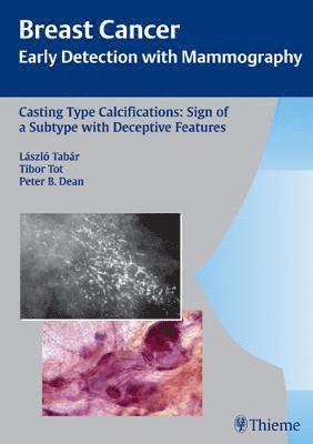 Casting Type Calcifications: Sign of a Subtype with Deceptive Features 1