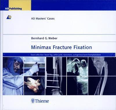 Minimax Fracture Fixation: Case Collection: Lower leg - ankle joint - nonunions - autogenous bone transplantation 1