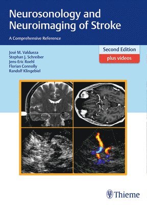 José Manuel Valdueza, Stephan Schreiber, Jens-Eric Röhl, Florian Connolly, Randolf Klingebiel, Jose Manuel Valdueza, Jens-Eric Rohl - Neurosonology and Neuroimaging of Stroke, Inbunden