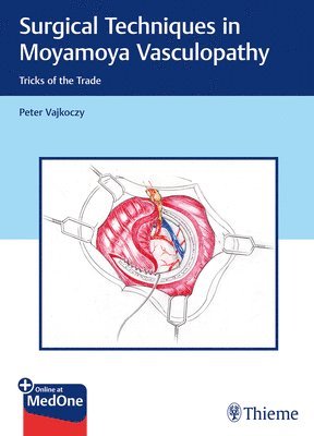 Surgical Techniques in Moyamoya Vasculopathy 1