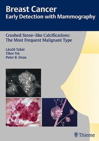 bokomslag Breast Cancer: Early Detection with Mammography: Crushed Stone-like Calcifications: The Most Frequent Malignant Type