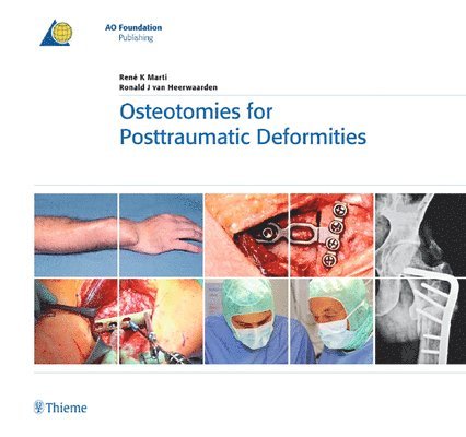 Osteotomies for Posttraumatic Deformities 1