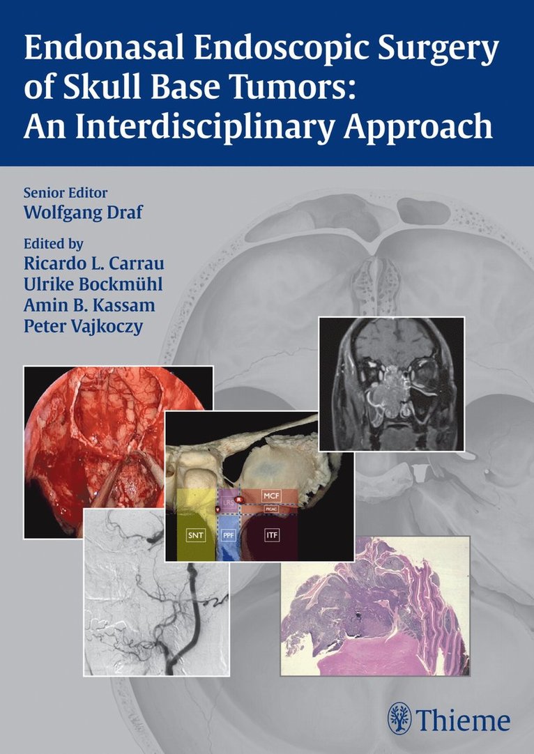 Endonasal Endoscopic Surgery of Skull Base Tumors: An Interdisciplinary Approach 1