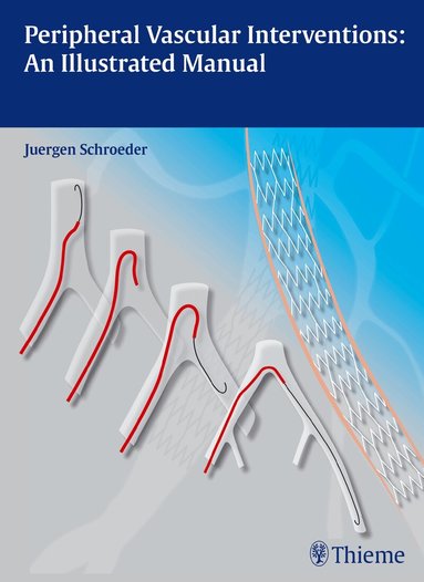 Jürgen Schröder - Peripheral Vascular Interventions: an Illustrated Manual, Inbunden