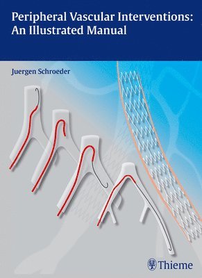 Jürgen Schröder, Jurgen Schroder - Peripheral Vascular Interventions: an Illustrated Manual, Inbunden