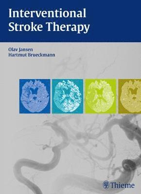 Interventional Stroke Therapy 1