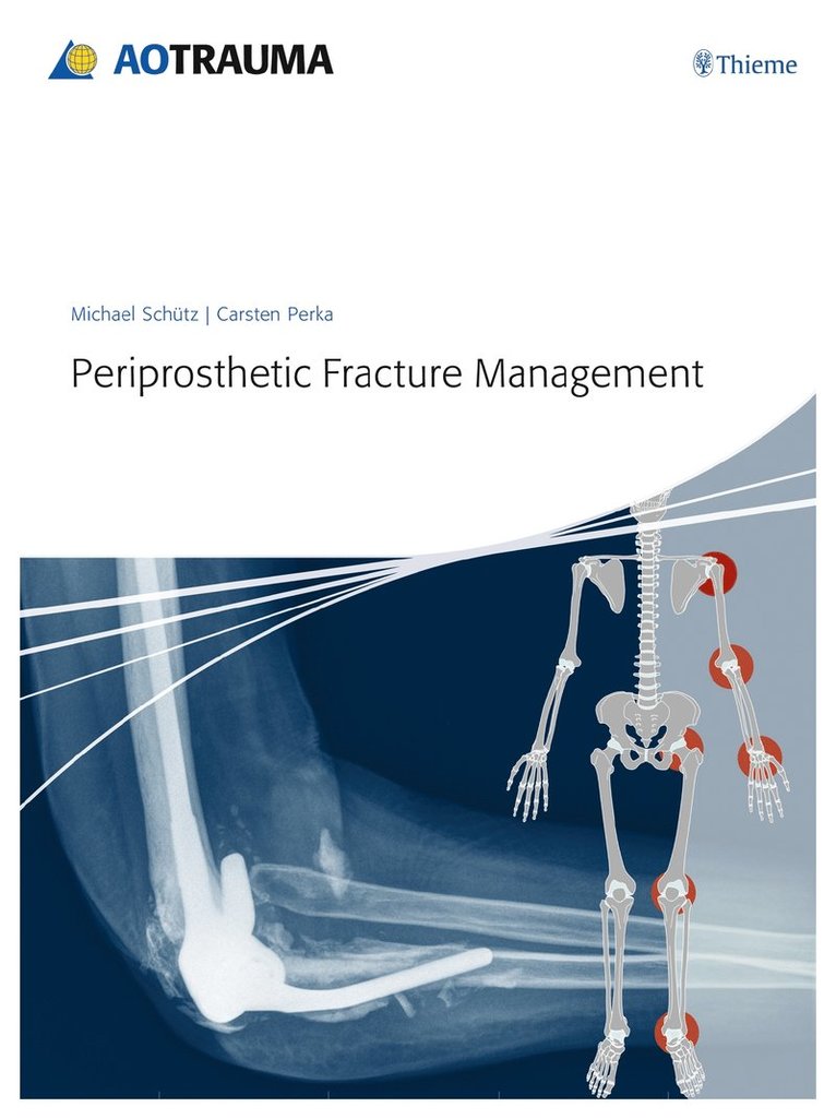 Michael Schütz, Carsten Perka, Michael Schutz - Periprosthetic Fracture Management, Inbunden
