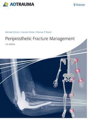 Periprosthetic Fracture Management 1