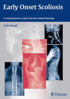 Colin Nnadi - Early Onset Scoliosis, Inbunden