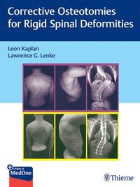 bokomslag Corrective Osteotomies for Rigid Spinal Deformities