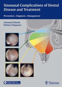 bokomslag Sinonasal Complications of Dental Disease and Treatment