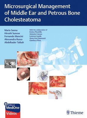 bokomslag Microsurgical Management of Middle Ear and Petrous Bone Cholesteatoma