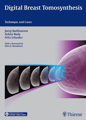 Digital Breast Tomosynthesis 1