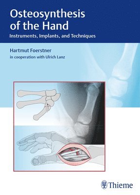 Osteosynthesis of the Hand 1