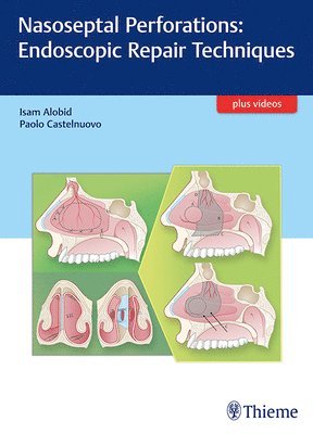 bokomslag Nasoseptal Perforations: Endoscopic Repair Techniques