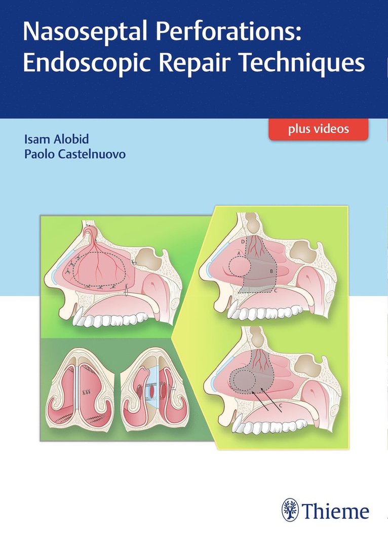 Nasoseptal Perforations: Endoscopic Repair Techniques 1