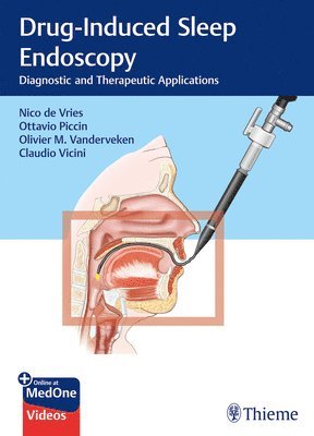 Drug-Induced Sleep Endoscopy 1