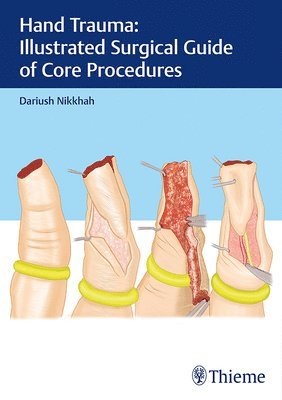 Hand Trauma: Illustrated Surgical Guide of Core Procedures 1