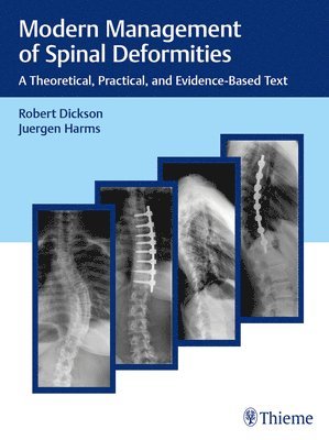 Robert A. Dickson, Jürgen Harms, Jurgen Harms, Robert a. Dickson - Modern Management of Spinal Deformities, Inbunden