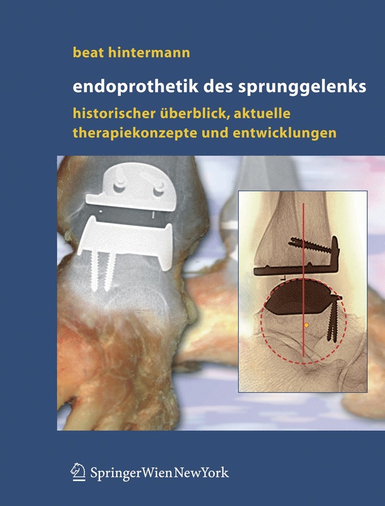 Beat Hintermann - Endoprothetik des Sprunggelenks, Inbunden