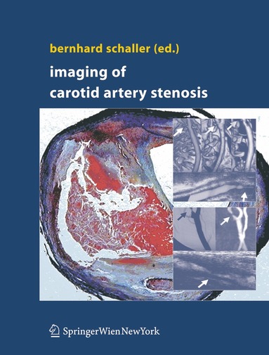 bokomslag Imaging of Carotid Artery Stenosis