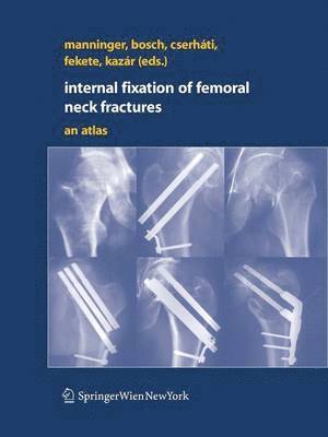 bokomslag Internal fixation of femoral neck fractures