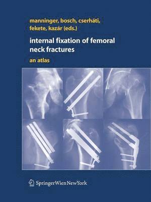 bokomslag Internal fixation of femoral neck fractures