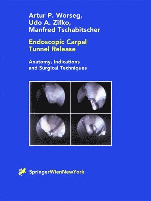 Endoscopic Carpal Tunnel Release