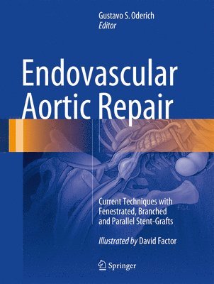 bokomslag Endovascular Aortic Repair