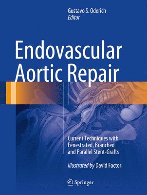 Endovascular Aortic Repair 1