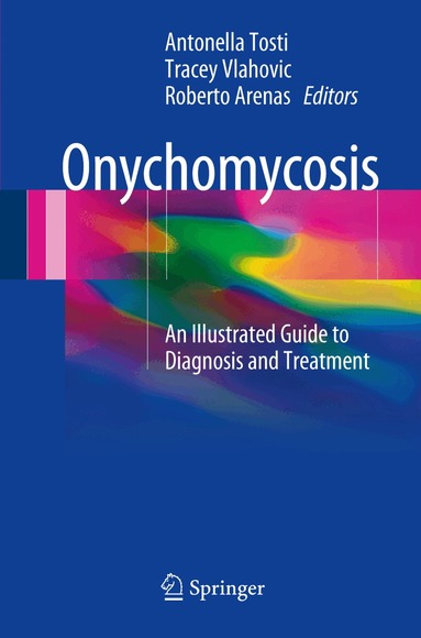 Antonella Tosti, Tracey C. Vlahovic, Roberto Arenas - Onychomycosis, Häftad
