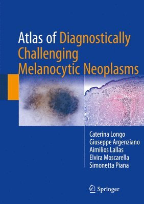 Atlas of Diagnostically Challenging Melanocytic Neoplasms 1